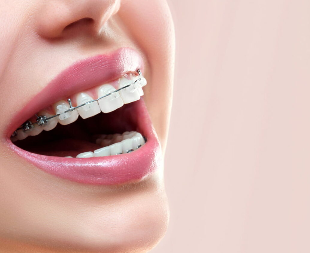Dental Braces