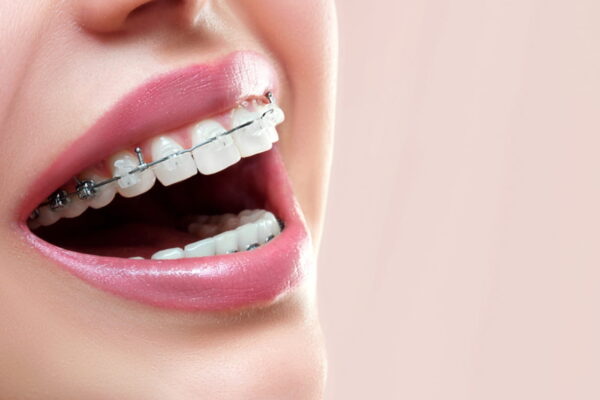 Dental Braces
