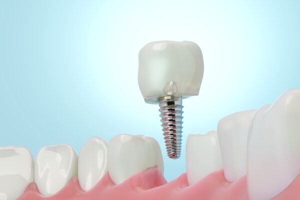 Benefits of a Single-Tooth Dental Implant