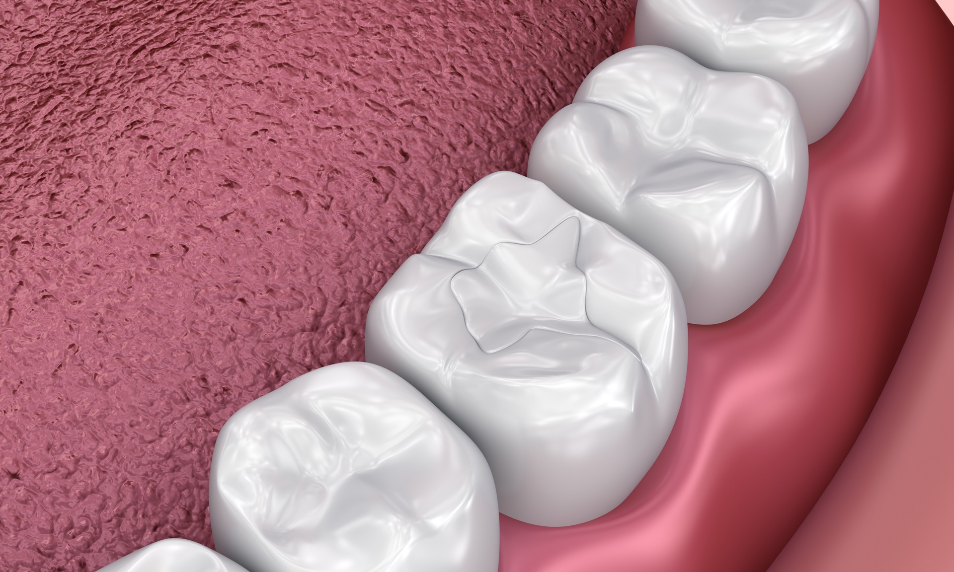 How White Fillings Can Enhance Your Smile