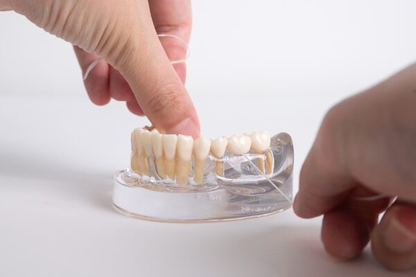 The Benefits of Dental Bridges: Why They’re a Smart Solution for Missing Teeth
